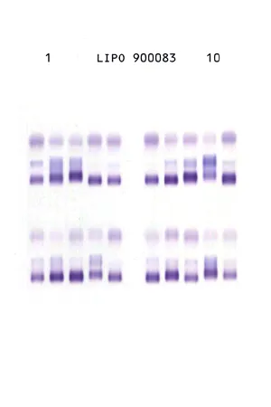 コレステロール分画パターン例