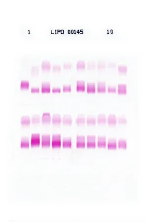リポ蛋白分画パターン例